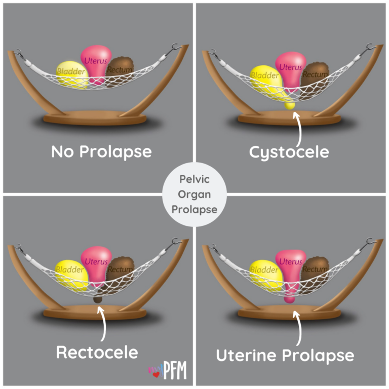 vaginal-prolapse-laser-treatment-protea-pelvic-floor-clinic-calgary